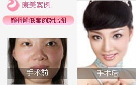颧骨整形前后对比图