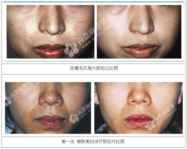 嫩肤美白前后对比图