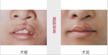 >>>唇裂修复术前后对比图   唇裂搭理患者唇部留有裂隙,单侧或双侧,常