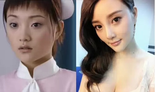 李小璐被疑整容了?