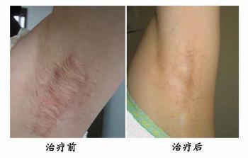 北京海军总医院微创腋臭祛除手术案例