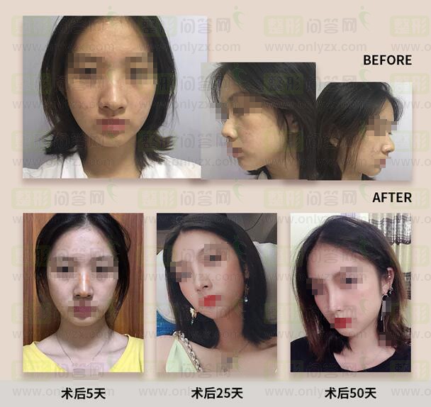 做个鼻子是没有什么多大问题的