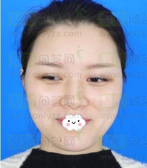 记录我的硅胶隆鼻后的变化