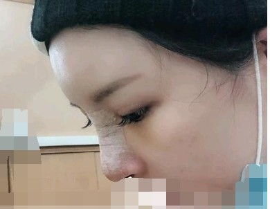 记录我的硅胶隆鼻后的变化