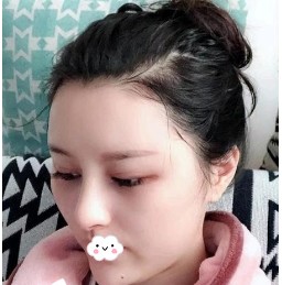 记录我的硅胶隆鼻后的变化