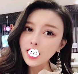 记录我的硅胶隆鼻后的变化