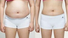 UltraShape