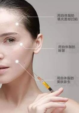 面部填充变“肥”为宝  自体脂肪转移大法
