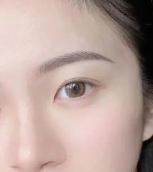 重塑精致深邃美眼 全切双眼皮术后效果非常惊喜